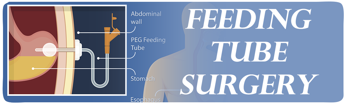 Feeding Tube Surgery